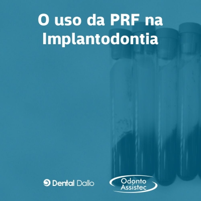 PRF na Implantodontia